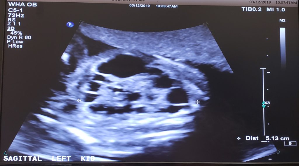 Multicystic Dysplastic (Left) Kidney at 22 weeks, 2 days gestation